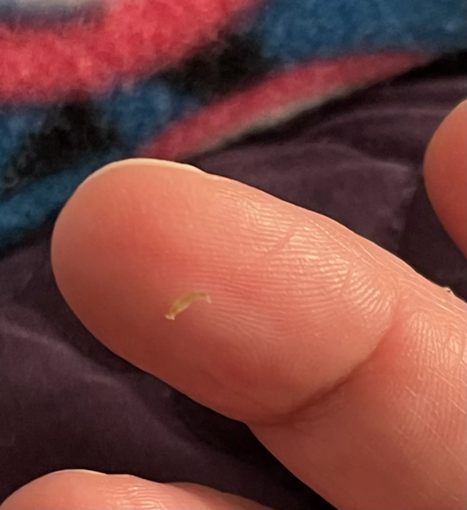 My son had a laparoscopic surgery when he was an infant. Every now and then, 10 years later, the tiny scar fills up and gets a black head. Got this cute little thing out of it just now! (No children were harmed during the squeezing) My son had a laparoscopic surgery when he was an infant. Every now and then, 10 years later, the tiny scar fills up and gets a black head. Got this cute little thing out of it just now! (No children were harmed during the squeezing)