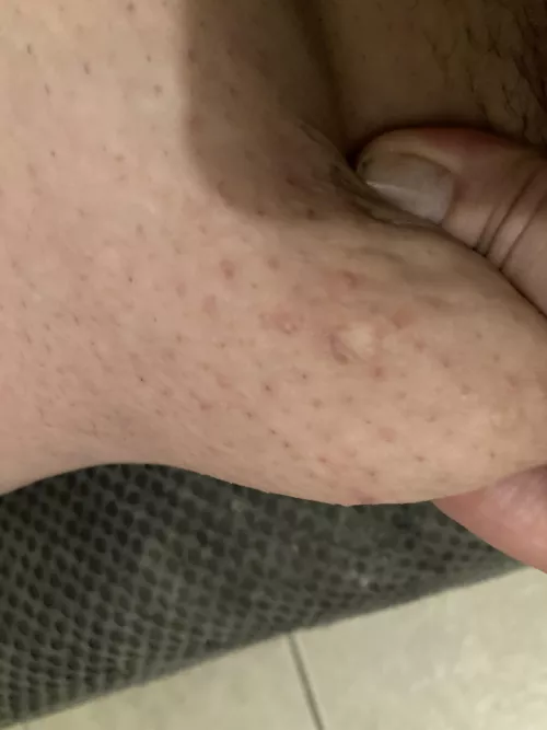 Need advice please. This is a pic of a portion of my upper thigh. My inner thighs are like this all over. I don’t know who can help or what I should do. Dermatologist? Self help? Salon? Been like this my entire adult life and I’m so self conscious ab