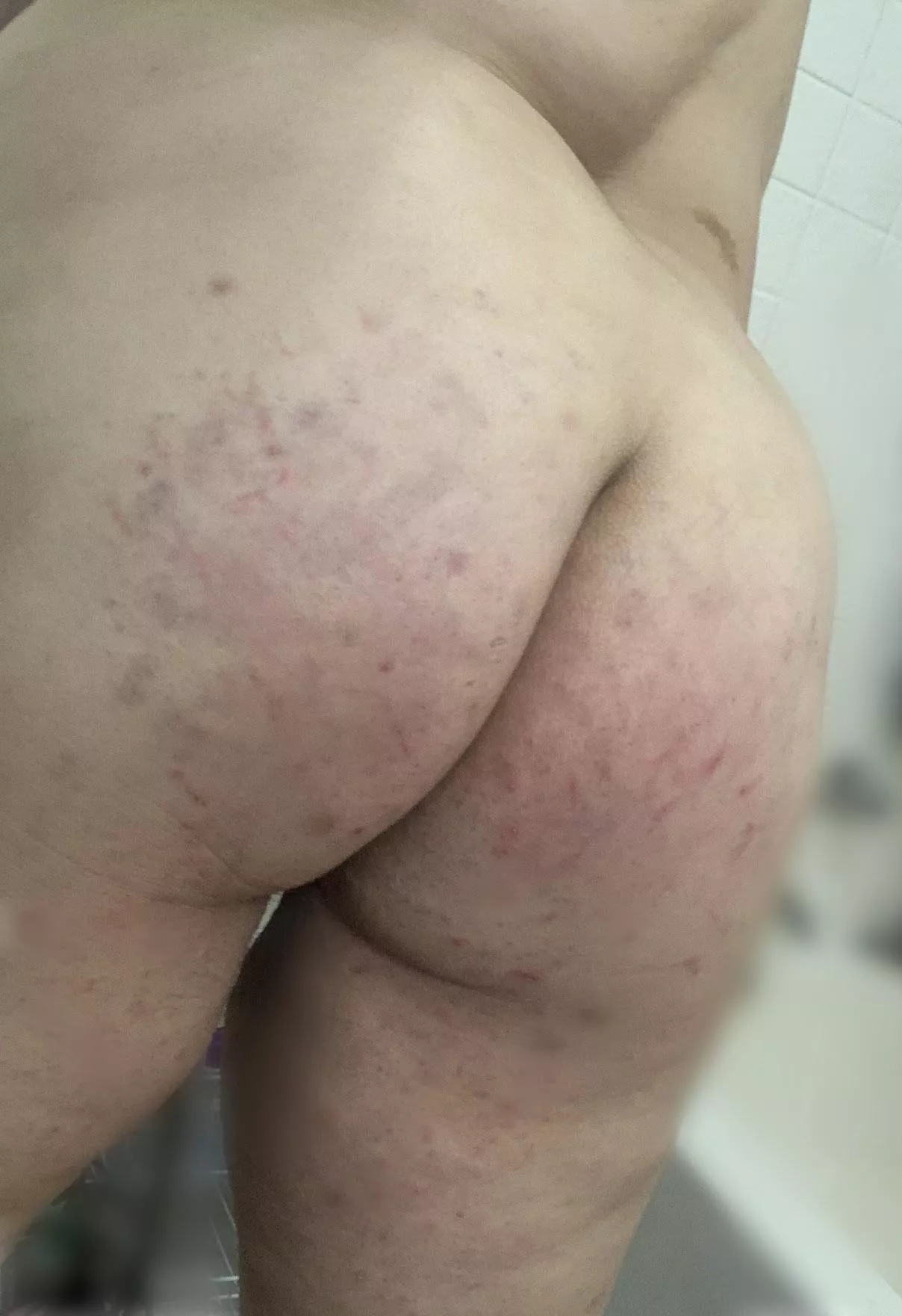 Next day bruises