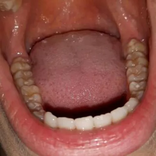 Odontophilia / teeth fetish