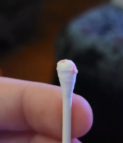 Painful and hard ear pop