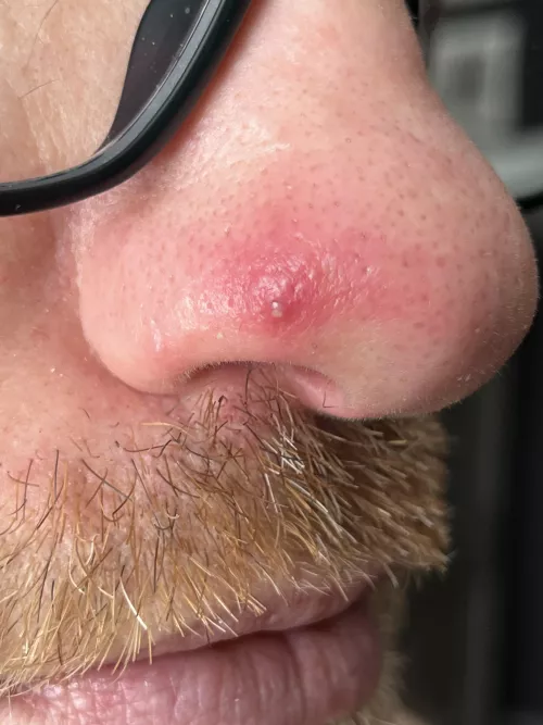 Popped this on my husbands nose. He said no video since even lightly touching it makes him cry. I almost cried cause I didn’t wanna hurt him.