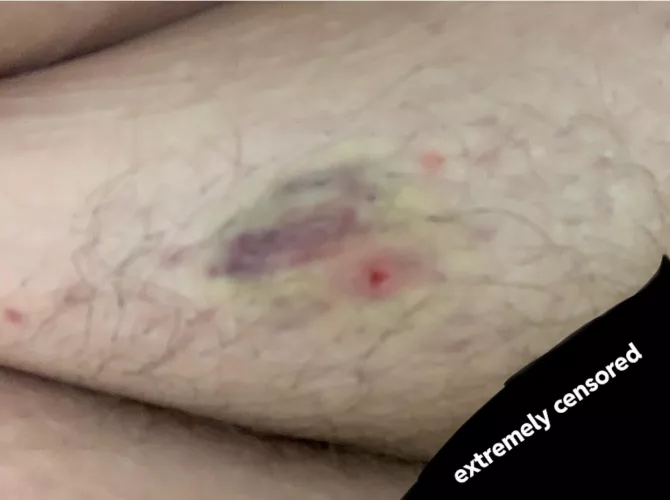 Poppers, beware! Had an ingrown hair on my coochie and apparently I squeezed too hard. Bruised, hurts to walk, extremely irritating. Be nice to your bodies, friends. NSFW even though you can’t see much.