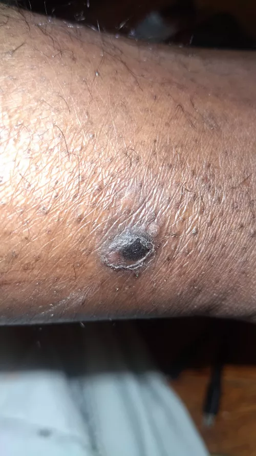 Posted previously here's how the bump currently looks