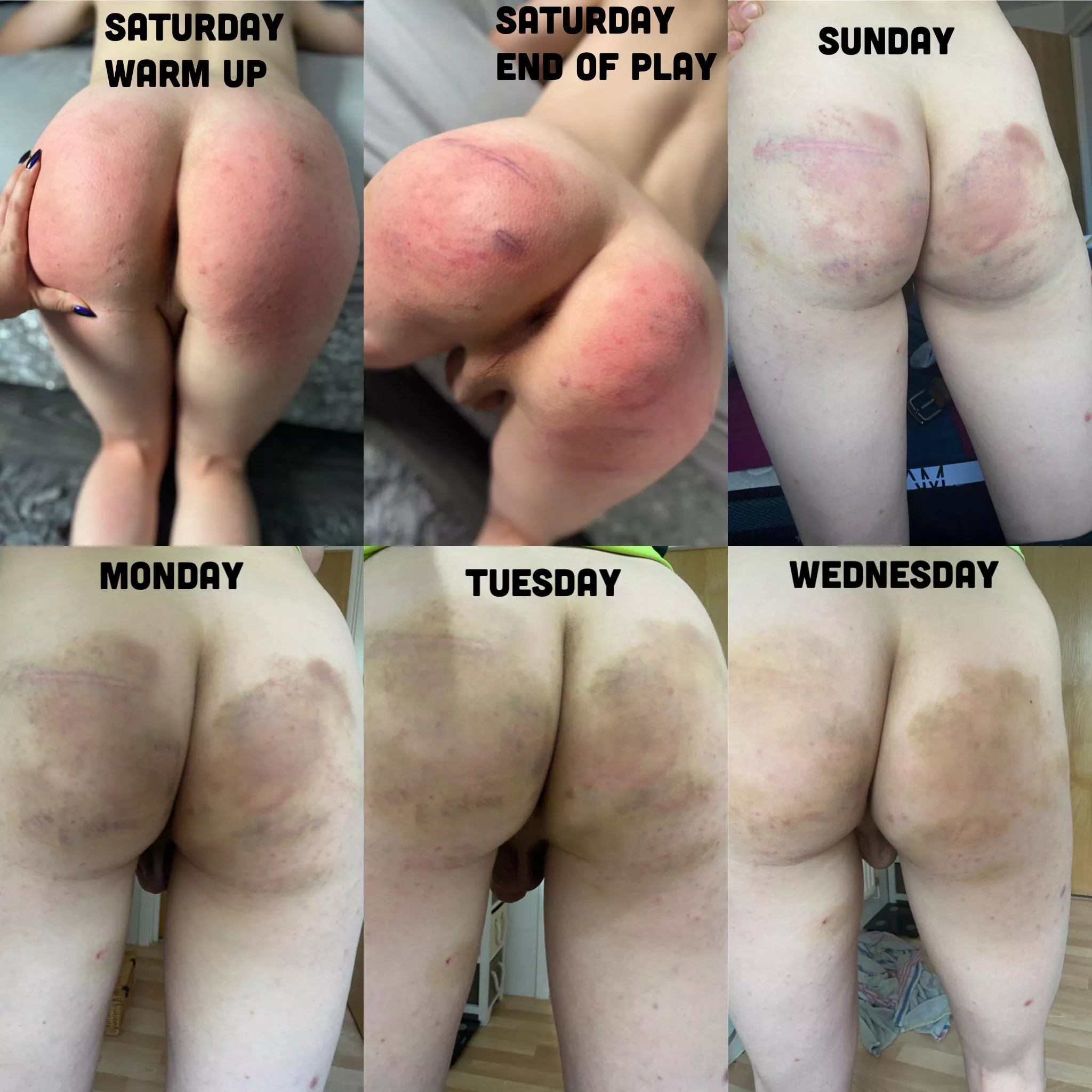 Progression of bruising from an amazing impact session with my Dutchess. A very tender but incredibly happy puppy š¤š Progression of bruising from an amazing impact session with my Dutchess. A very tender but incredibly happy puppy š¤š