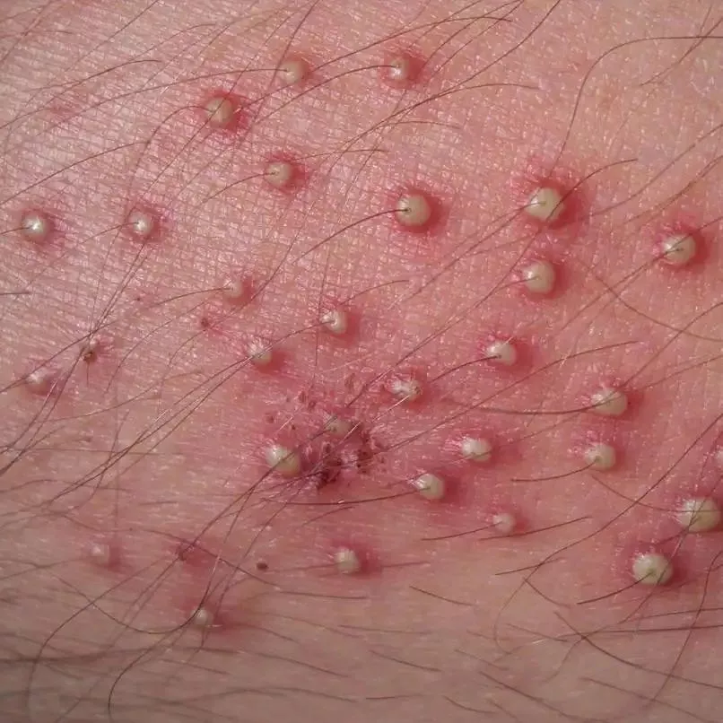 Saw this picture when googling pimple hairs. I would pay GOOD money to pluck those hairs out and pop the pus out after 🤤😭 Saw this picture when googling pimple hairs. I would pay GOOD money to pluck those hairs out and pop the pus out after 🤤😭