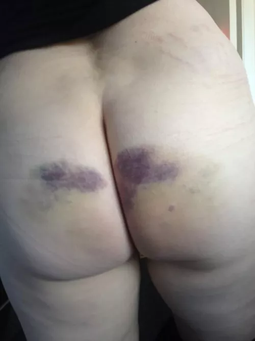 Second day of going to work with a bruised bottom my naughty secret