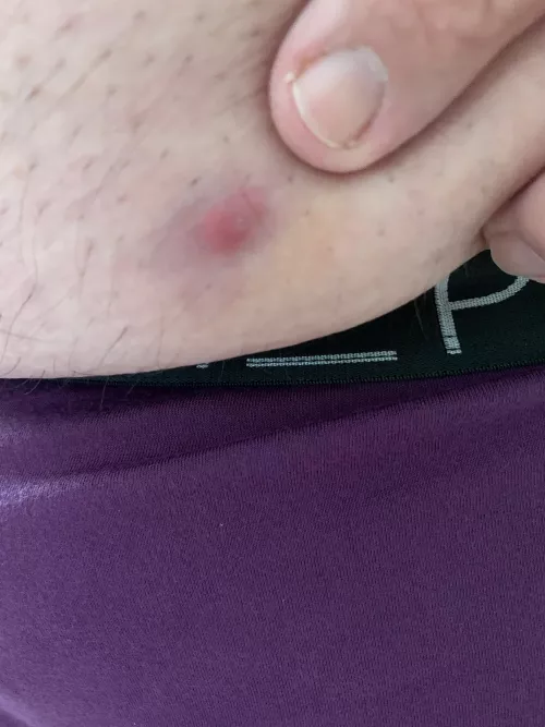 So it begins…ingrown or pus.