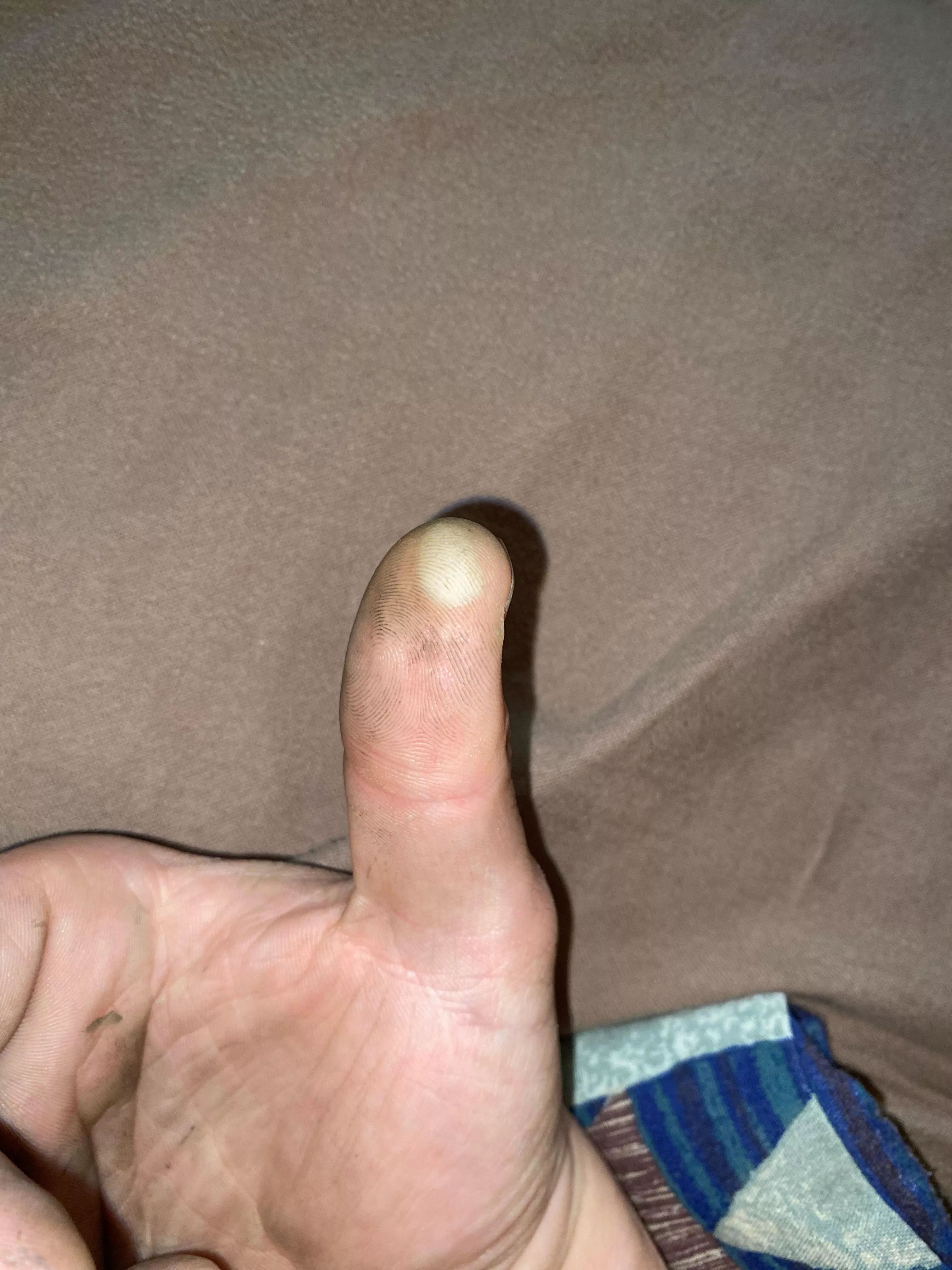 sorry about the dirty hands, just came from work and this stuff is impossible to get off. But does this blister look infected? 3-4 weeks old from working on car. sorry about the dirty hands, just came from work and this stuff is impossible to get off. But does this blister look infected? 3-4 weeks old from working on car.