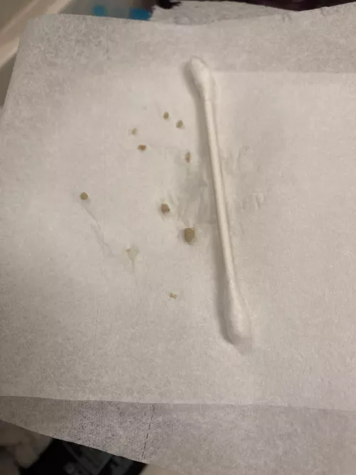 These guys popped out after I brushed my teeth… ugh q-tip for scale