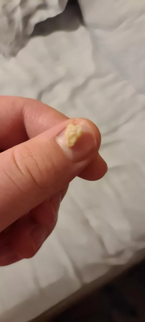 this bad boy came out of my tonsils when i woke up