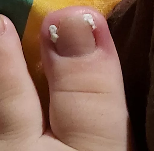 this bitch will keep growing no matter how many times I go to the doctor so... I'll just let it be 🤣btw the white thing is toilet paper