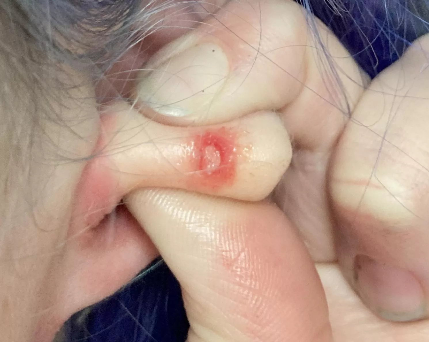 Thoughts on what this is? Redness isn’t infection - I have tried plucking this out and its bled. I was thinking scar tissue?
