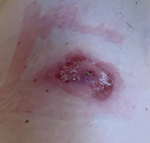 TL;DR - a formerly benign cyst went haywire when my immune system ramped up to fight covid. Had it lanced, then I was allergic to the antibacterial infused bandaids I bought to cover it. I'm in hell.