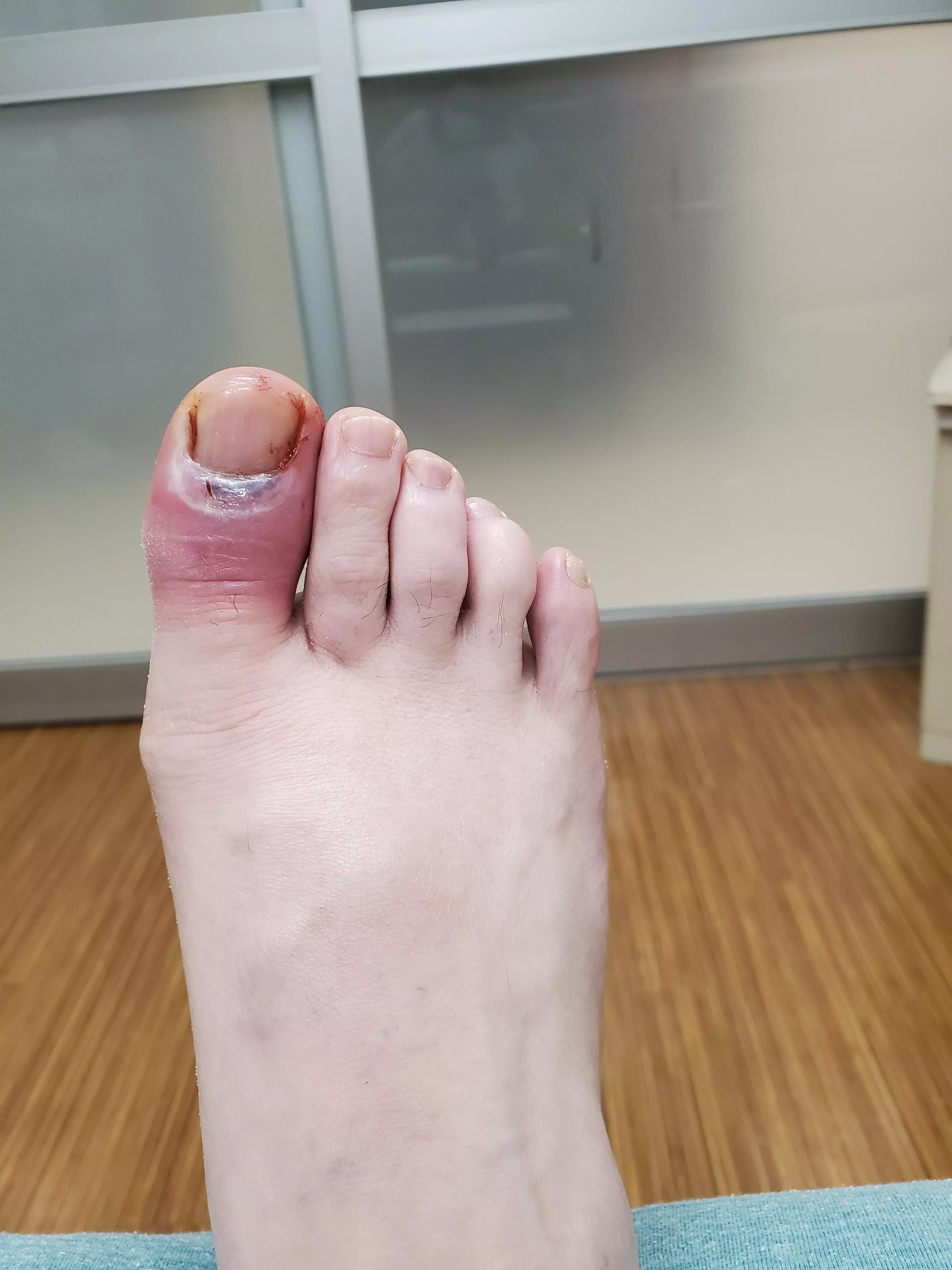 UPDATE: my toe should be okay! it looks worse, but that's normal. I'm on antibiotics for the next ten days. Thanks to everyone who told me to go in! UPDATE: my toe should be okay! it looks worse, but that's normal. I'm on antibiotics for the next ten days. Thanks to everyone who told me to go in!