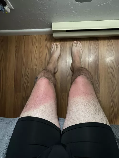 Who wants to worship these feet and rub lotion on my sunburn 🥵