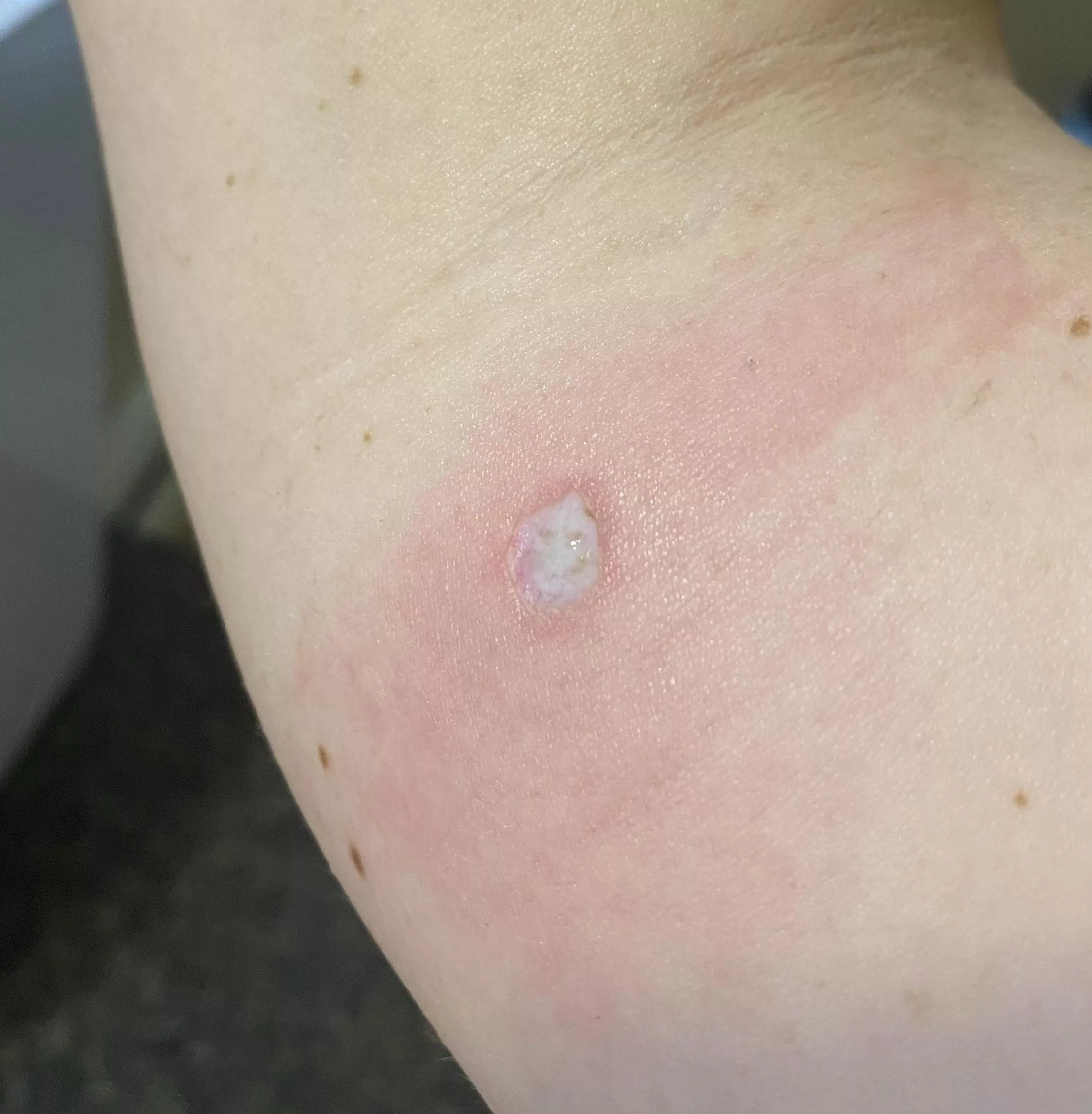 A few days after I had a mole removed for biopsy, and itβs healing up beautifully. Almost in time for spooky szn π A few days after I had a mole removed for biopsy, and itβs healing up beautifully. Almost in time for spooky szn π