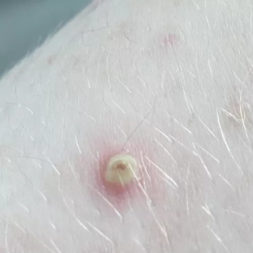 angry keratosis pilaris after popping a day before (sorry i don’t have a video, but you know it’s a good one when it’s yellow lol, had to share)