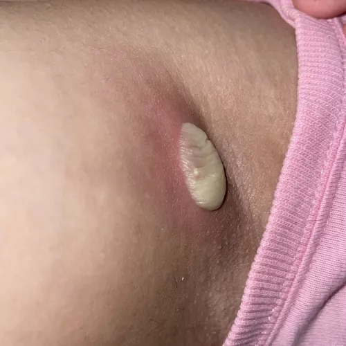 Anybody know what this is? It’s at the armpit area, maybe lymph node? It’s also swollen at the inner surrounding area