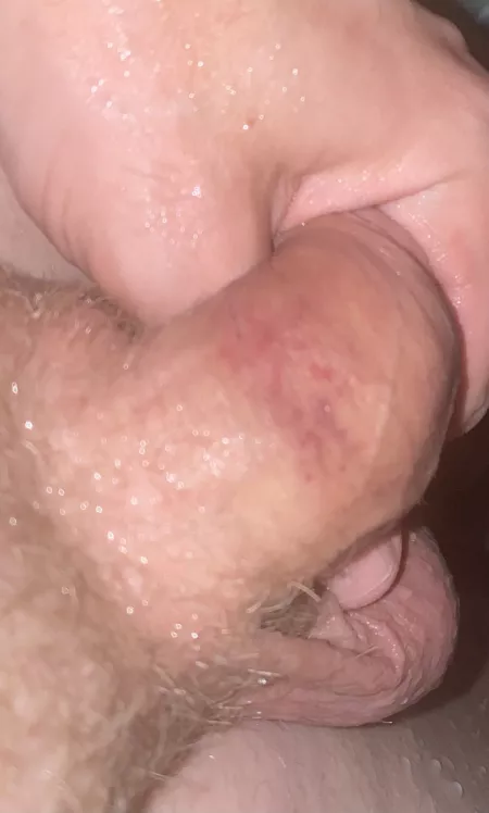 Blisters/irritation from pumping