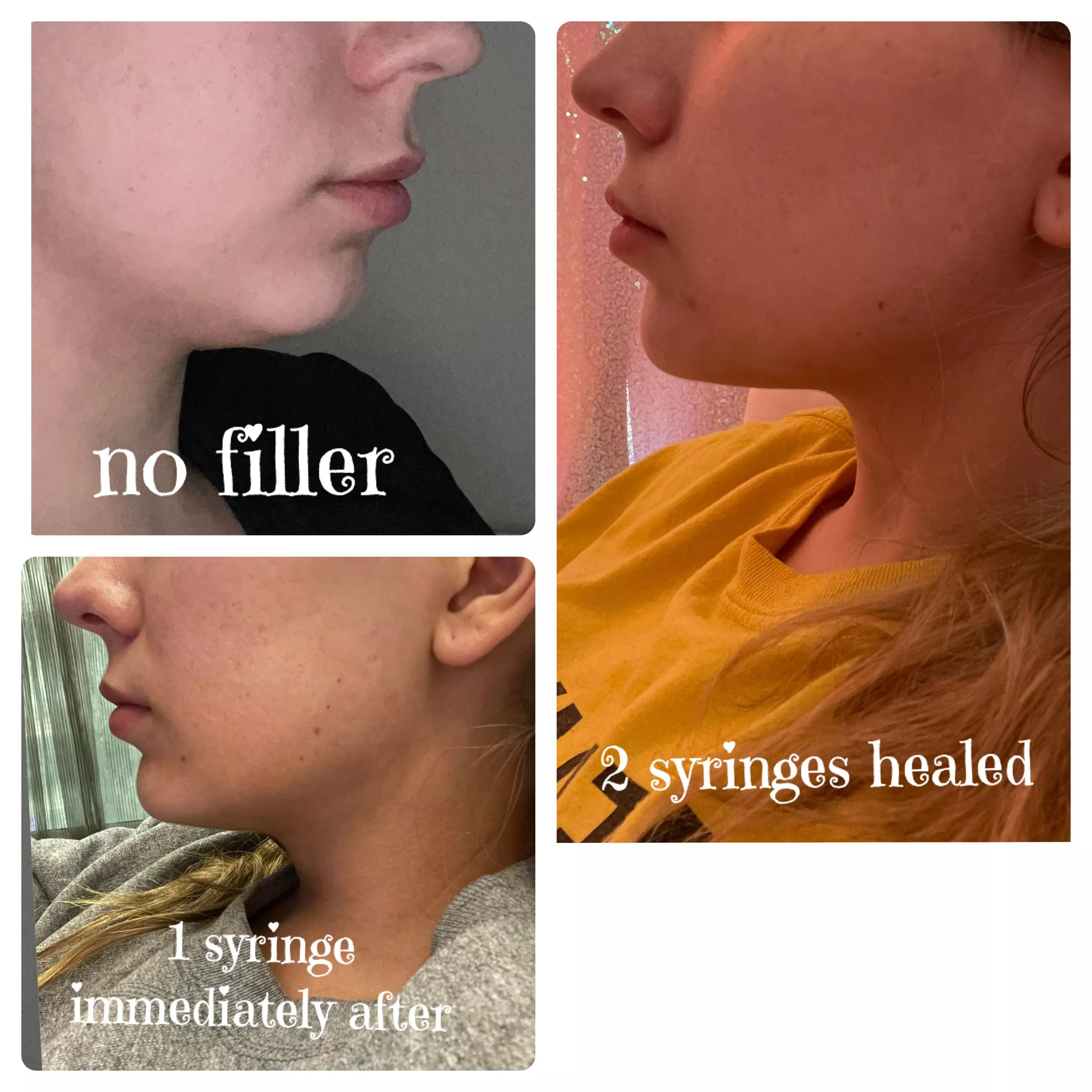 Chin Filler Progress! Balance is so important 💕