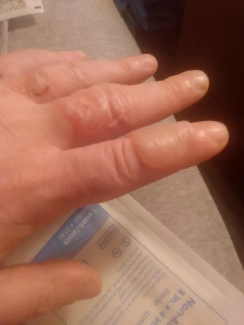 Do hot oil burn blisters belong here? Both fingers already drained. Index is ready for round 2.