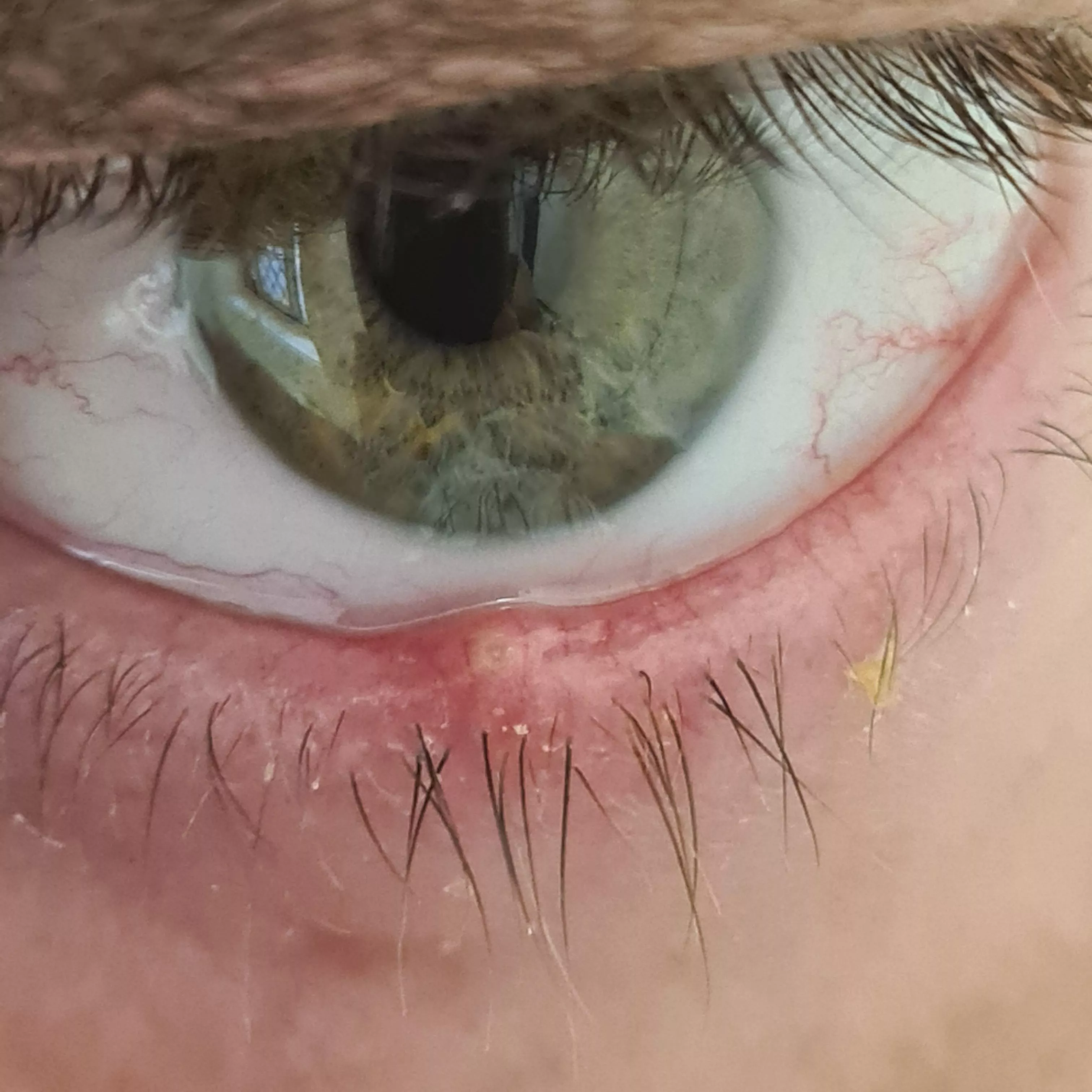 Forbidden pop... π« Doesn't hurt too bad, just a really irritating and annoying pressure, which showed up overnight. Hot compress so far, told the Mrs will go see the Dr if doesn't resolve after a couple days. Forbidden pop... π« Doesn't hurt too bad, just a really irritating and annoying pressure, which showed up overnight. Hot compress so far, told the Mrs will go see the Dr if doesn't resolve after a couple days.