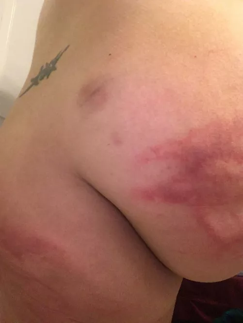 He got me good my first time . This is 2 days afterwards .. it stayed with me about a week