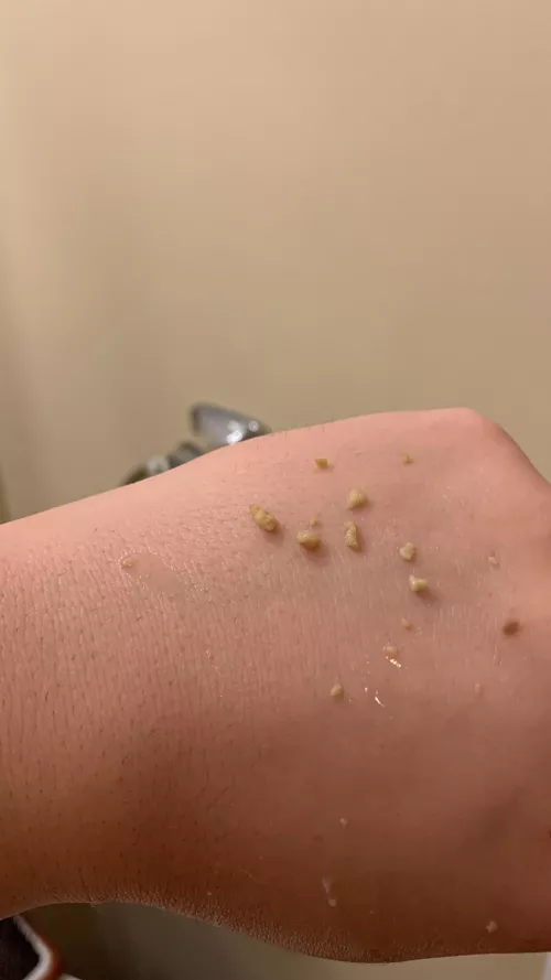 I just got over a head cold and had the ~grossest~ tonsil clean-out ever 🤢