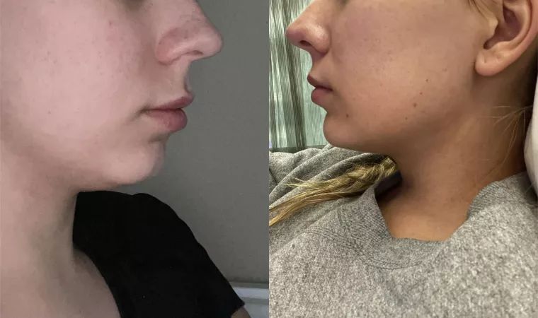 I know that people really love lip filler here, but I decided to show off my chin filler before/after too in case any bimbos are curious!
