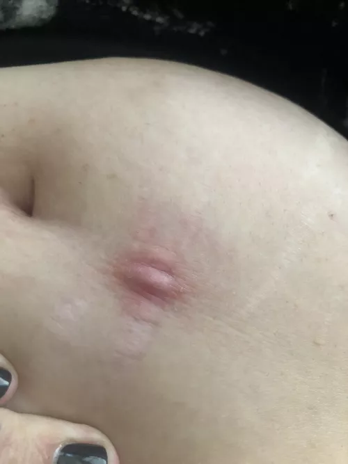 I know this was a perfect storm, but if you have a blackhead on a stretch mark in a belly fold, probably don’t poke around and pop it with not the cleanest hands. This doesn’t feel good!