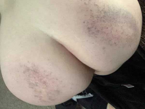 I love my bruises after a scene 😍 [F]