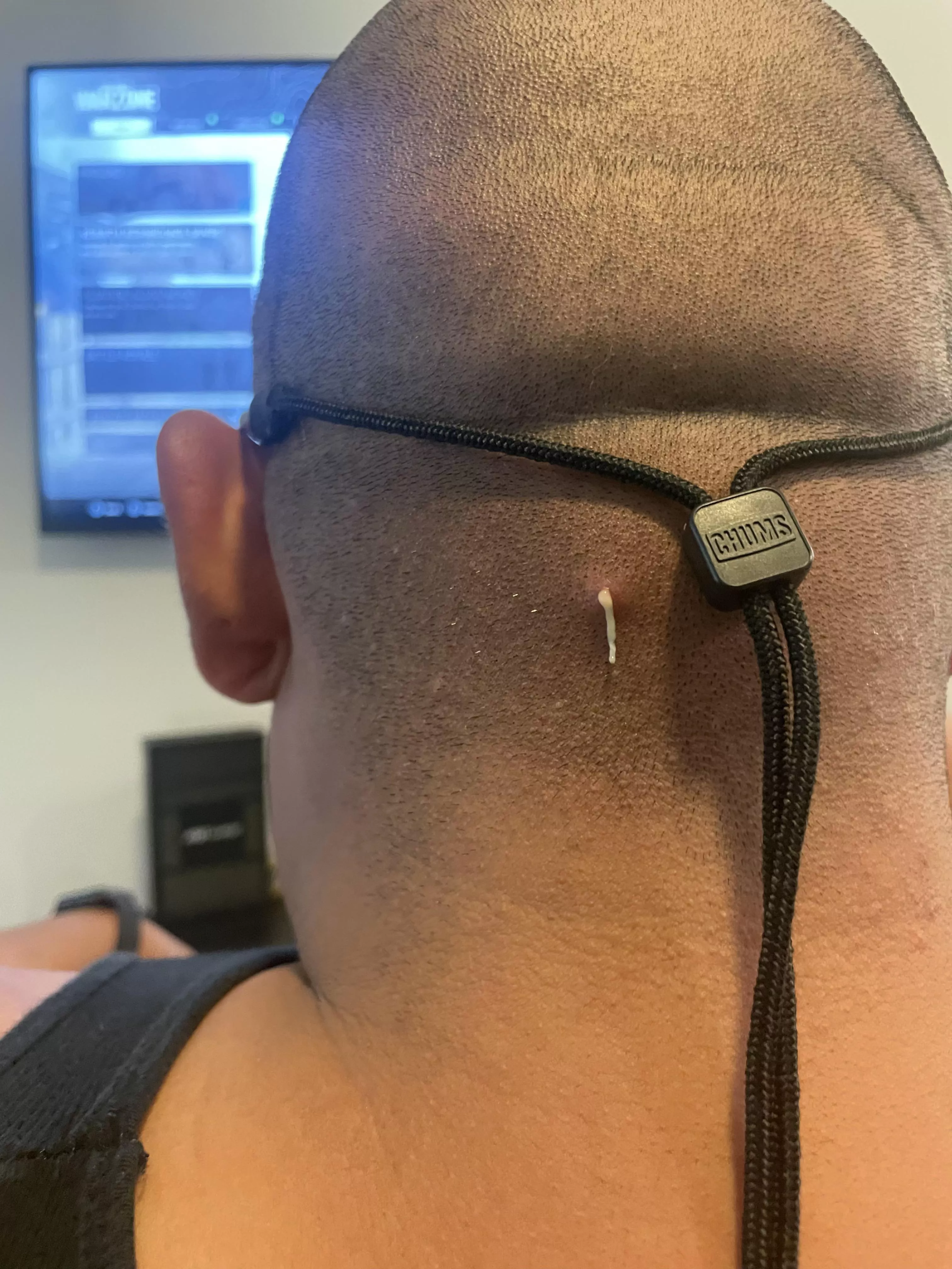 My fiancé said he had some pain in the back of his head. Didn’t realize his hard had gave him a massive pimple. Best pop ever! My fiancé said he had some pain in the back of his head. Didn’t realize his hard had gave him a massive pimple. Best pop ever!