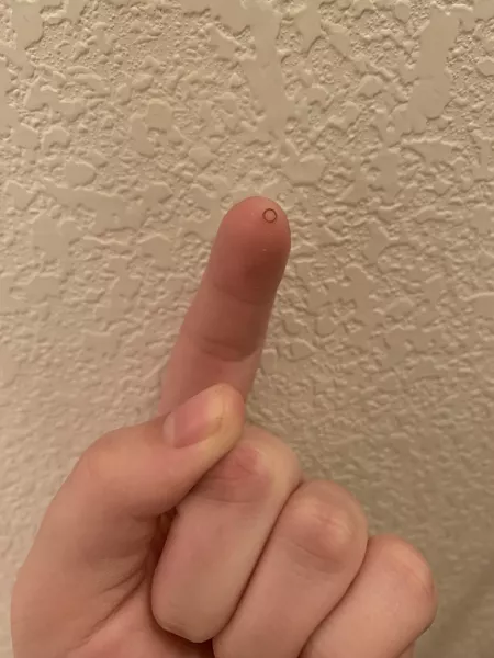 Perfectly circle ingrown hair from a few days ago