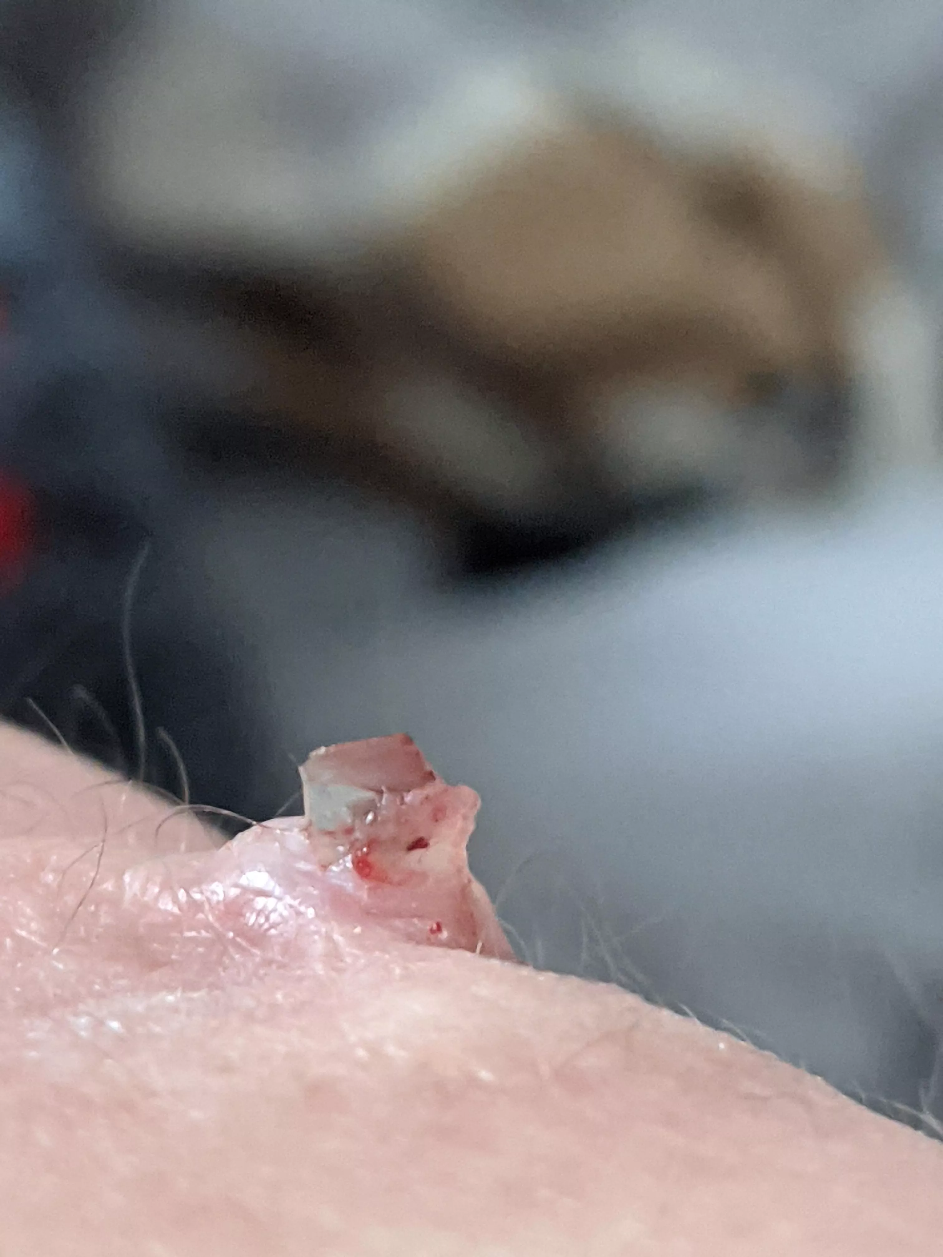 Piece of glass finally came out of my elbow after my accident in 2017
