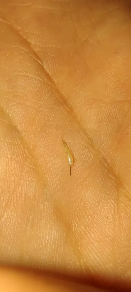 Popped this out of my labia. Tbh didn't expect anything to come out.