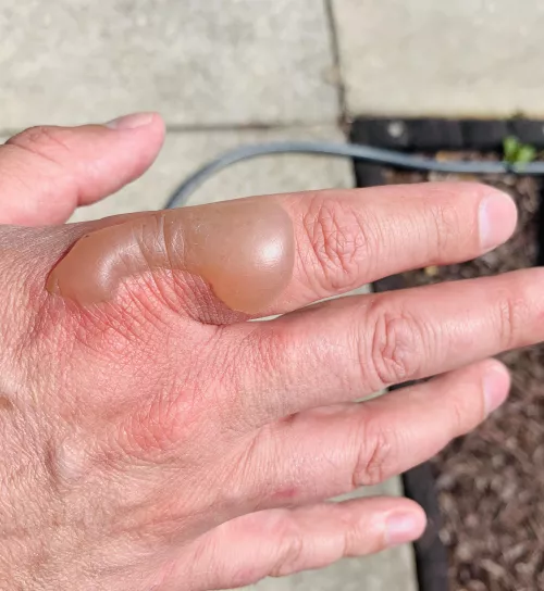 Steam burn blister from washing hot pan!