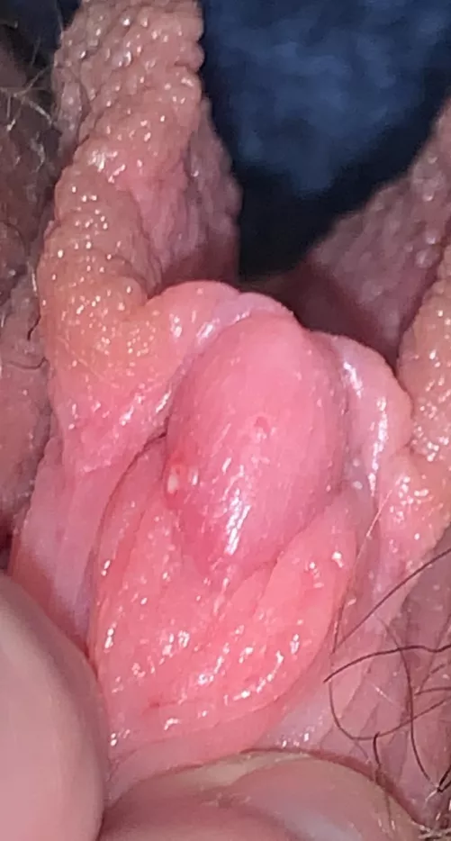 the return of dick zit: i popped it, but it’s not done with me yet. it wasn’t even satisfying. will keep you all updated