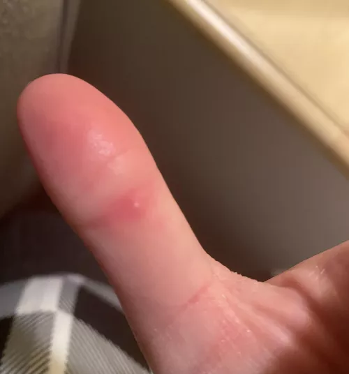 Tiny, painful, hard white bump right on the inside of the knuckle on my thumb. This is what I presume is a forbidden pop… has anyone else gotten something like this before? It hurts like mad to bend my thumb. It’s hard to see but the center of the bu