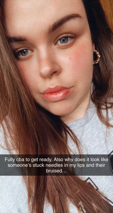 Today my DSL’s looked like I had fillers… no fillers here hunny.