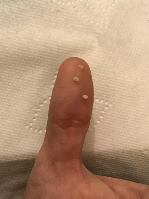 Today’s Tonsil Stone Haul