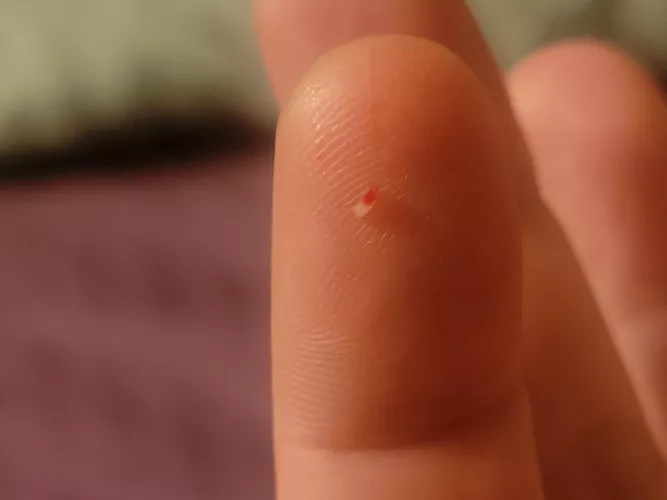 What is this? I get these hard sores for weeks and finally have to dig this little fucker out. The sores heal around it otherwise. Photo of hole in comments.