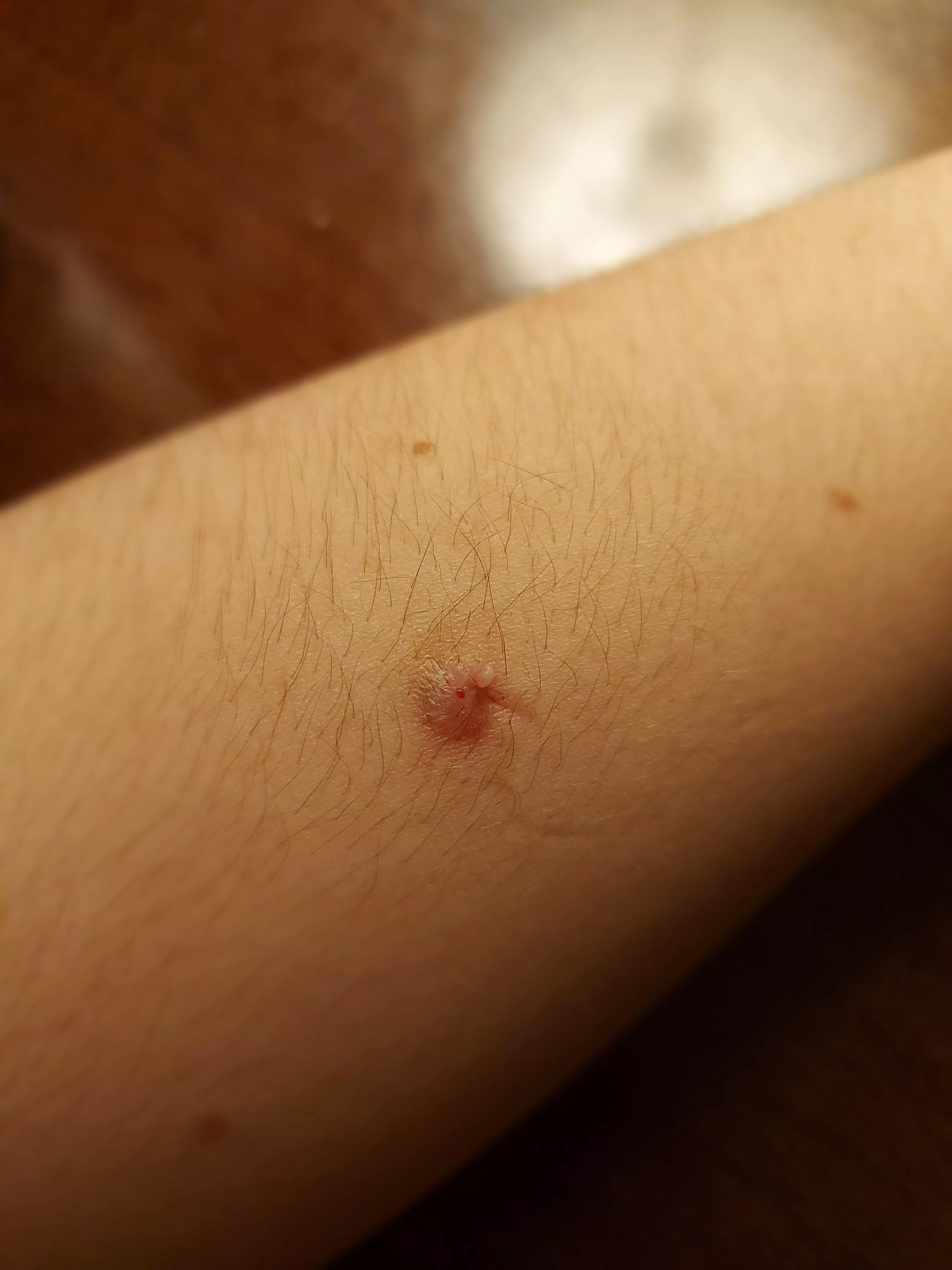 What is this on my arm? The skin around is rough, and it's the fifth time I've had to pop it. I have keratosis on my arms but have seen nothing like this before What is this on my arm? The skin around is rough, and it's the fifth time I've had to pop it. I have keratosis on my arms but have seen nothing like this before